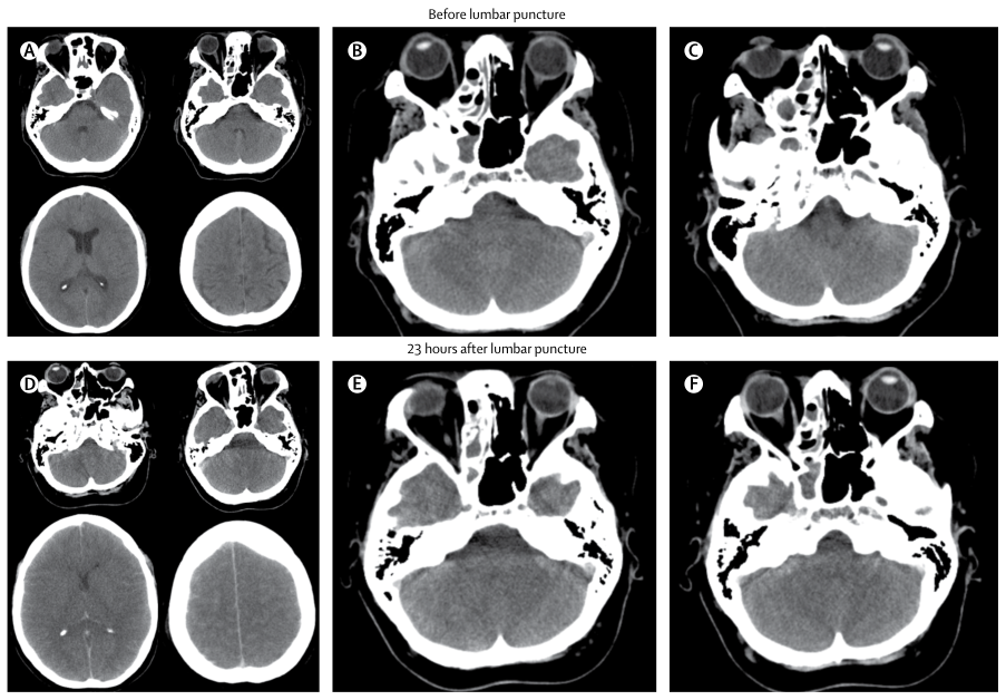 腰穿有什么用腰穿前需要停用阿司匹林吗？还有哪些禁忌症？腰穿 6 问 6 答_https://www.jmylbn.com_新闻资讯_第3张