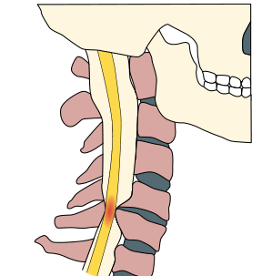 腰穿有什么用腰穿前需要停用阿司匹林吗？还有哪些禁忌症？腰穿 6 问 6 答_https://www.jmylbn.com_新闻资讯_第4张