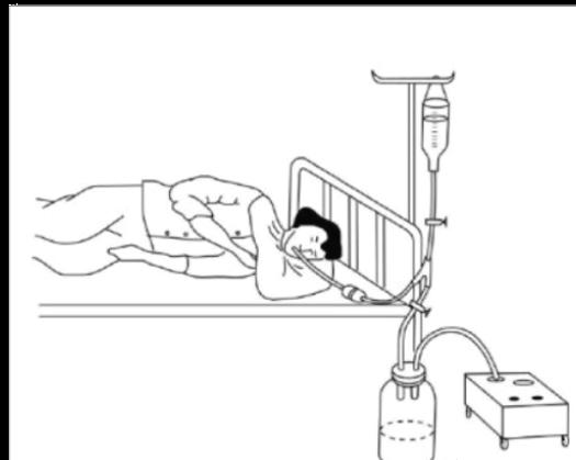 洗胃去什么科【五院·科普】常见急救知识——洗胃术_https://www.jmylbn.com_新闻资讯_第2张