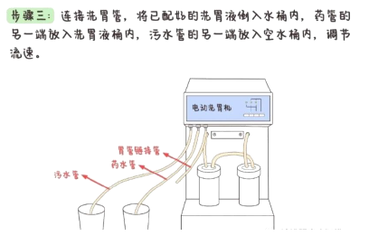 洗胃去什么科【五院·科普】常见急救知识——洗胃术_https://www.jmylbn.com_新闻资讯_第6张