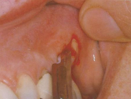 牙科手机怎么消毒【五院·科普】牙科手机的清洗消毒与维护保养_https://www.jmylbn.com_新闻资讯_第3张