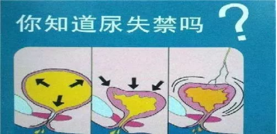 尿道张力过强怎么回事【灵一技术】泌尿外科成功开展多例经阴道闭孔无张力尿道中段悬吊术_https://www.jmylbn.com_新闻资讯_第6张