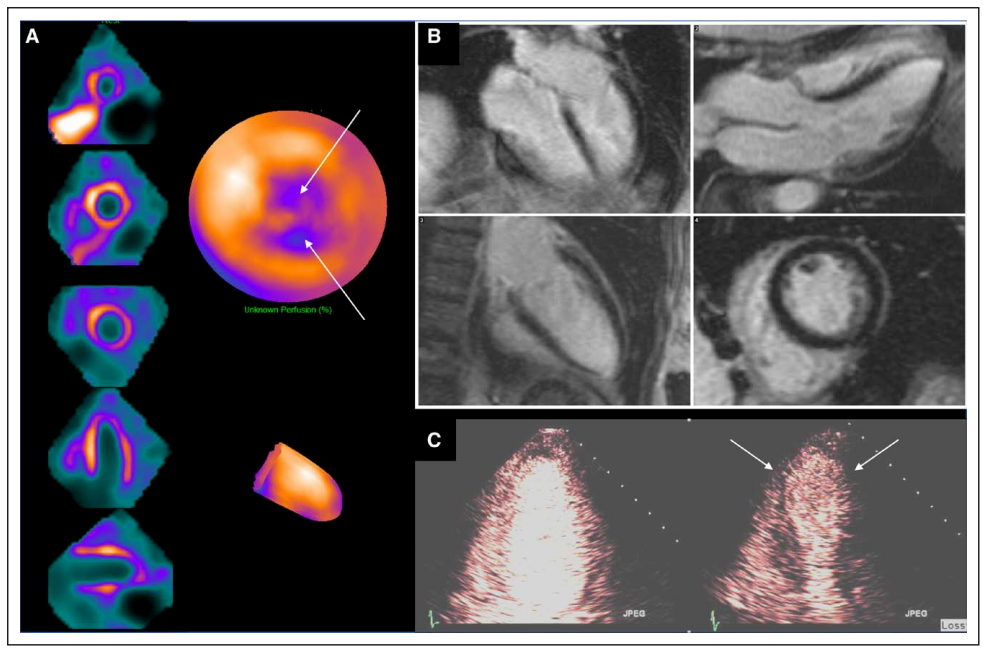 d-spect怎么检查“哀莫大于心死” — ¹²³I-MIBG SPECT显像带您可视化 “心死” 的神经支配_https://www.jmylbn.com_新闻资讯_第5张