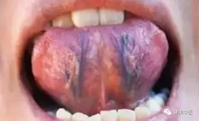 舌下取栓一一重启生命之脉