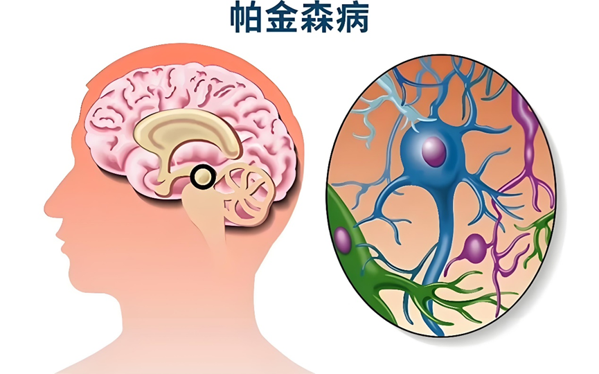 小身材，大作用——外泌体与神经退行性疾病