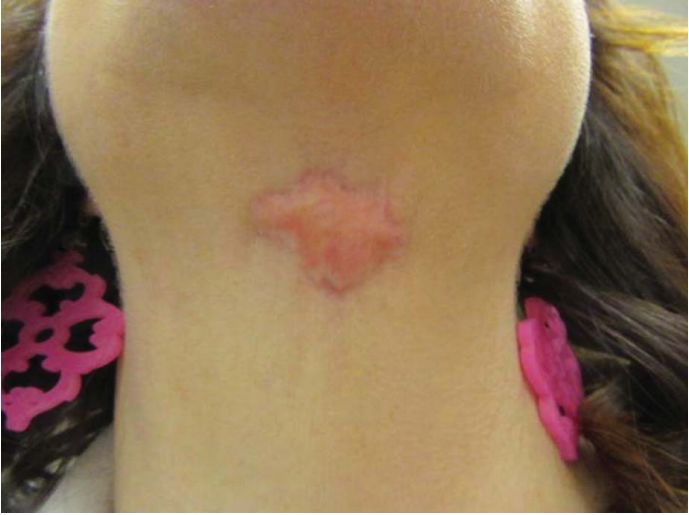         Kybella             -     btxa 