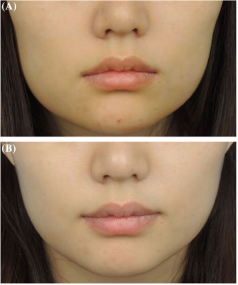 黑科技 肉毒毒素 微笑唇 注射法 肉毒毒素btxa 微信公众号文章阅读 Wemp