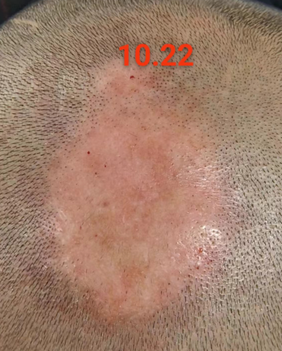 斑秃怎么办？看中医如何根治！