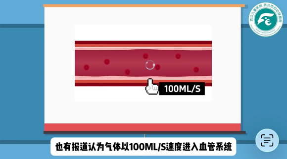 加压输液什么意思正确认识“空气栓塞”——静脉输液中气泡的真相与应对_https://www.jmylbn.com_新闻资讯_第6张