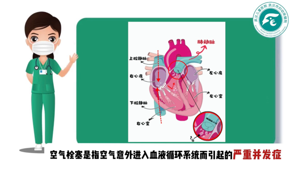 加压输液什么意思正确认识“空气栓塞”——静脉输液中气泡的真相与应对_https://www.jmylbn.com_新闻资讯_第4张