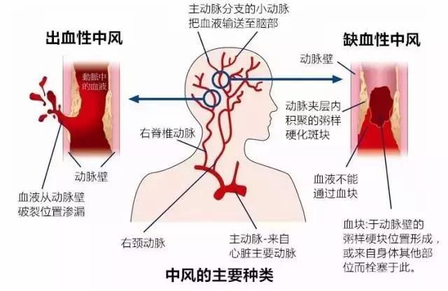 中國人的「頭號殺手」不是癌症，是它！ 健康 第4張