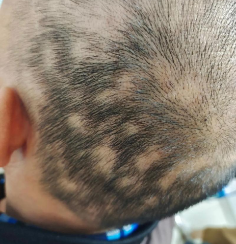 梅毒还能导致脱发？梅毒性脱发与其他常见脱发的症状辨别