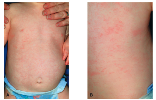 你家孩子經歷過「熱退疹出」嗎？面對幼兒急疹，家長應該這樣做！ 親子 第2張