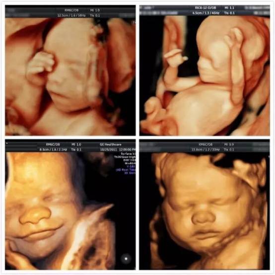 ge彩超是什么胎儿排畸利器 ｜ 美国GE-E8四维彩超,见证宝宝的精彩瞬间!_https://www.jmylbn.com_新闻资讯_第5张