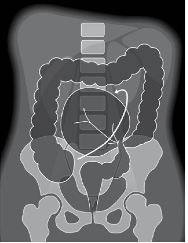 肠袋缺失:当肠管明显扩张时,结肠袋变平致显示欠清.