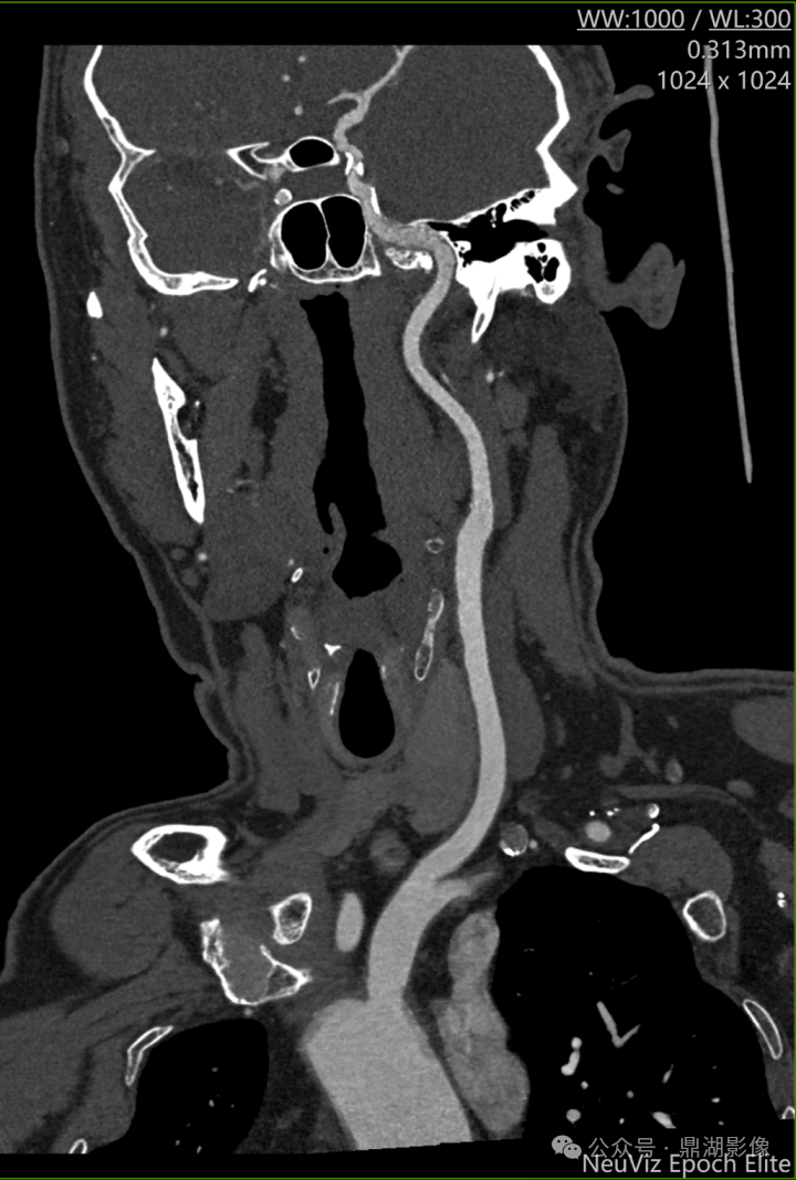 国产的医用ct有哪些国产“双”光子CT横空出世！国产超高端CT的“王炸”来了！_https://www.jmylbn.com_新闻资讯_第9张