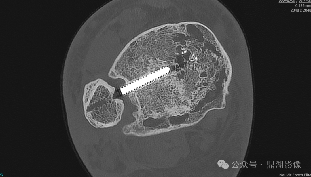 国产的医用ct有哪些国产“双”光子CT横空出世！国产超高端CT的“王炸”来了！_https://www.jmylbn.com_新闻资讯_第13张