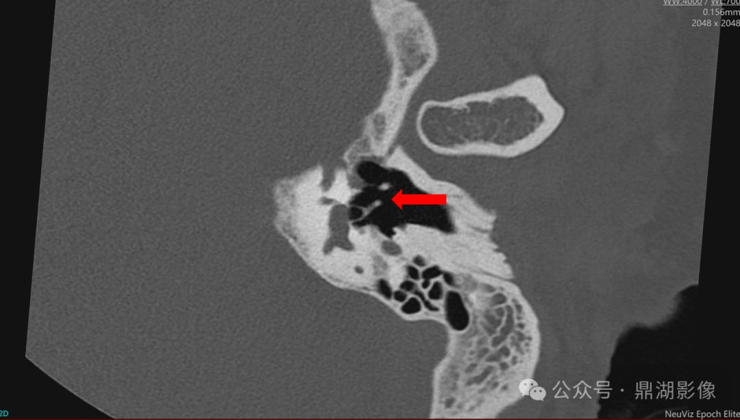 国产的医用ct有哪些国产“双”光子CT横空出世！国产超高端CT的“王炸”来了！_https://www.jmylbn.com_新闻资讯_第10张