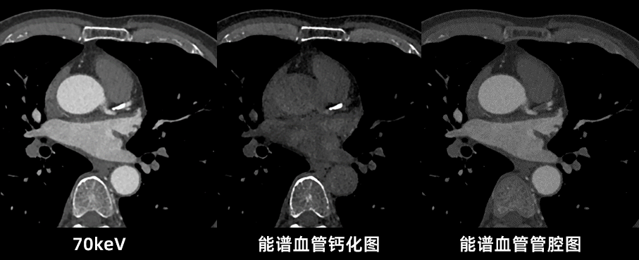 什么是联影ct真香预警？联影医疗双宽体双源CT大揭秘！TA竟然可以看到心脏的高清运动！_https://www.jmylbn.com_新闻资讯_第22张