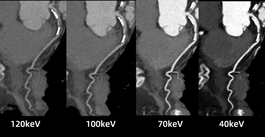 什么是联影ct真香预警？联影医疗双宽体双源CT大揭秘！TA竟然可以看到心脏的高清运动！_https://www.jmylbn.com_新闻资讯_第23张