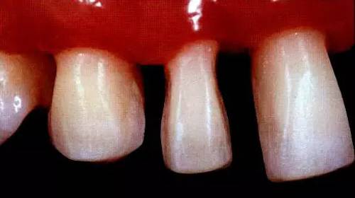 四种特殊贴面的预备方法