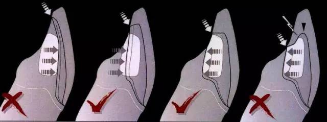 四种特殊贴面的预备方法