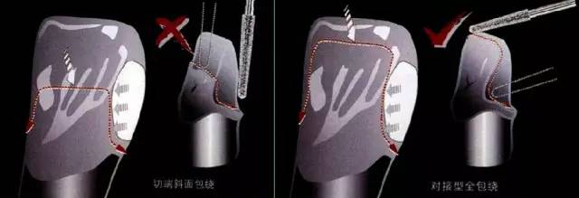 四种特殊贴面的预备方法