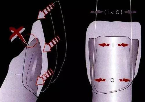 四种特殊贴面的预备方法
