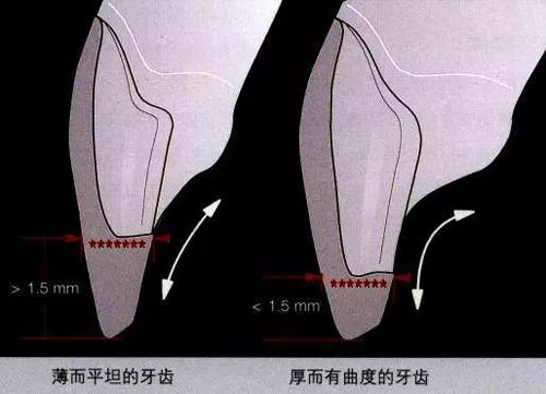 四种特殊贴面的预备方法