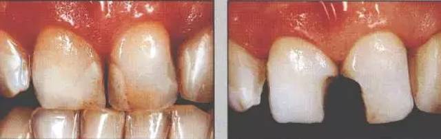 四种特殊贴面的预备方法