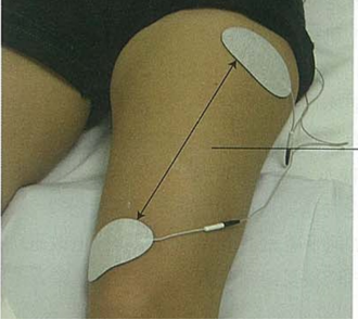 低频电刺激是什么科普｜低频之神经肌肉电刺激_https://www.jmylbn.com_新闻资讯_第15张