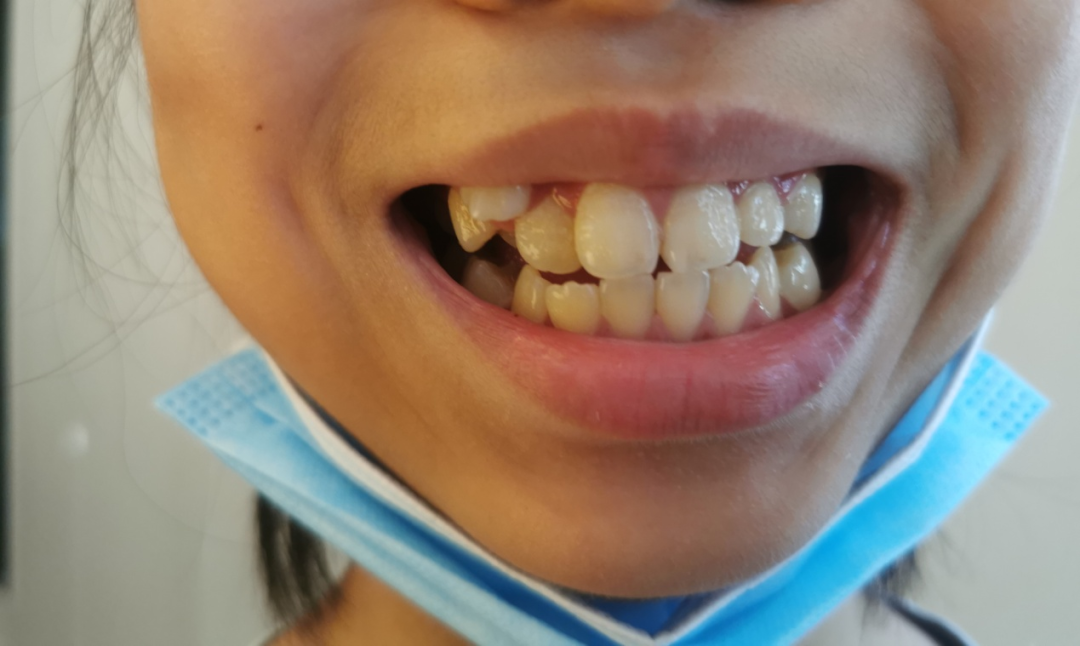 牙齿矫正分期