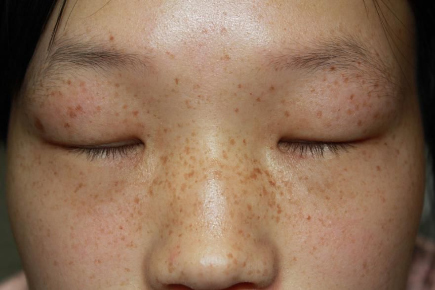 脸上雀斑有损颜值 皮肤科专家帮你搞定新年 面子问题 养生堂 日常养生保健大全 养生小知识 微信头条新闻公众号文章收集网