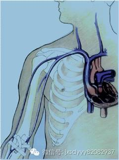 picc导管是什么材质化疗为什么需要置管？关于PICC管，您想知道的都在这里了！_https://www.jmylbn.com_新闻资讯_第3张