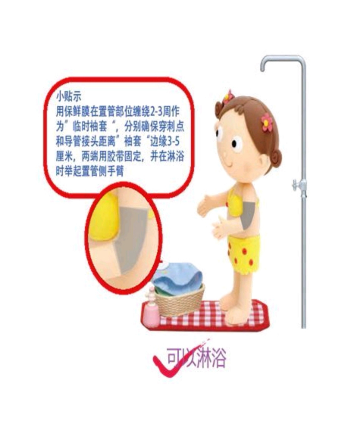 picc导管是什么材质化疗为什么需要置管？关于PICC管，您想知道的都在这里了！_https://www.jmylbn.com_新闻资讯_第12张