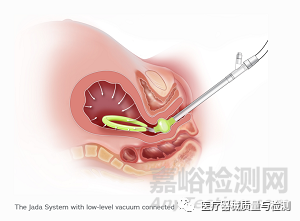 什么是创新医疗器械2021年最具创新性的24个医疗器械_https://www.jmylbn.com_新闻资讯_第23张