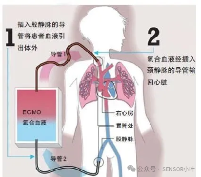 壓力傳感器在ECMO體外膜肺氧合器的應(yīng)用