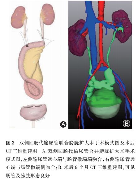 尿路修复 回肠代输尿管联合膀胱扩大术治疗输尿管狭窄合并膀胱挛缩的初步研究 中华泌尿外科杂志公众订阅号 微信公众号文章阅读 Wemp