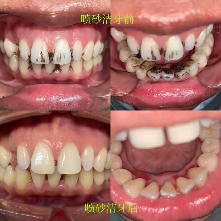 牙周治疗仪怎么做牙周【新设备新技术】普定县人民医院口腔科引进超声喷砂牙周治疗仪，助力牙齿健康_https://www.jmylbn.com_新闻资讯_第7张