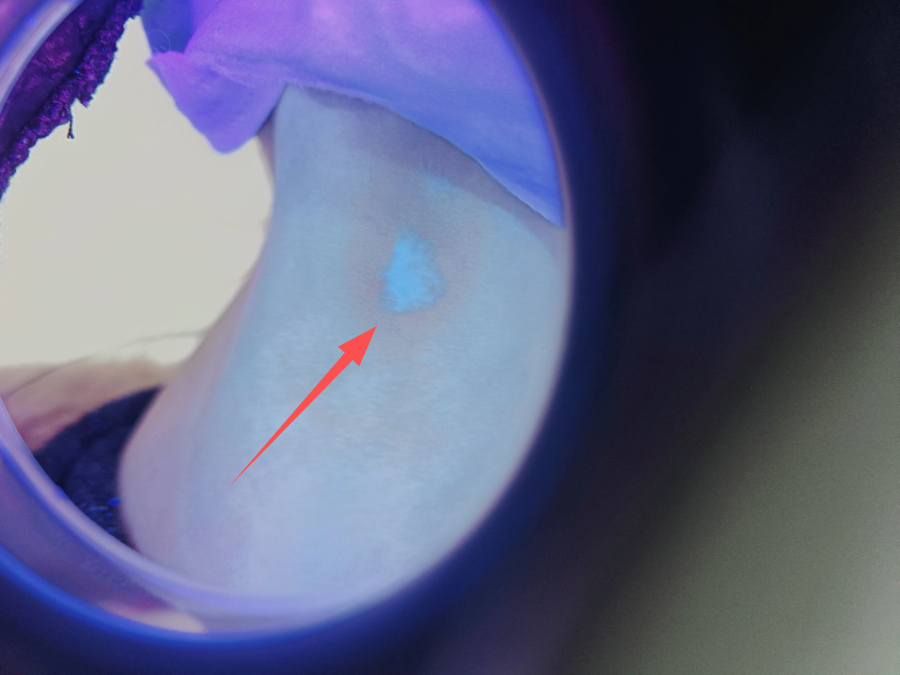 4006B光疗怎么用【新设备 新运用】治疗白癜风的308紫外线光疗仪哪里有？快来第十师北屯市总医院！_https://www.jmylbn.com_新闻资讯_第6张