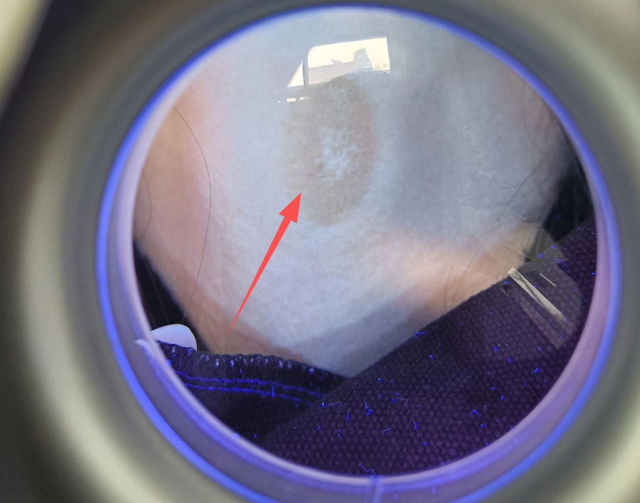 4006B光疗怎么用【新设备 新运用】治疗白癜风的308紫外线光疗仪哪里有？快来第十师北屯市总医院！_https://www.jmylbn.com_新闻资讯_第7张