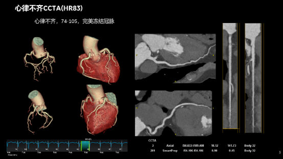 ge ct有哪些型号不怕超重 自由呼吸 ｜ GE Revolution CT显神奇，实现完美冠脉CTA检查！_https://www.jmylbn.com_新闻资讯_第18张