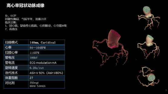 ge ct有哪些型号不怕超重 自由呼吸 ｜ GE Revolution CT显神奇，实现完美冠脉CTA检查！_https://www.jmylbn.com_新闻资讯_第20张