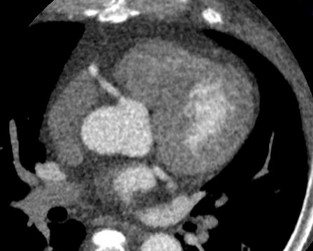 ge ct有哪些型号不怕超重 自由呼吸 ｜ GE Revolution CT显神奇，实现完美冠脉CTA检查！_https://www.jmylbn.com_新闻资讯_第6张