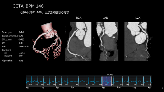 ge ct有哪些型号不怕超重 自由呼吸 ｜ GE Revolution CT显神奇，实现完美冠脉CTA检查！_https://www.jmylbn.com_新闻资讯_第19张