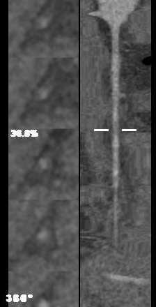 ge ct有哪些型号不怕超重 自由呼吸 ｜ GE Revolution CT显神奇，实现完美冠脉CTA检查！_https://www.jmylbn.com_新闻资讯_第12张