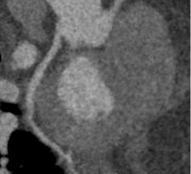 ge ct有哪些型号不怕超重 自由呼吸 ｜ GE Revolution CT显神奇，实现完美冠脉CTA检查！_https://www.jmylbn.com_新闻资讯_第9张