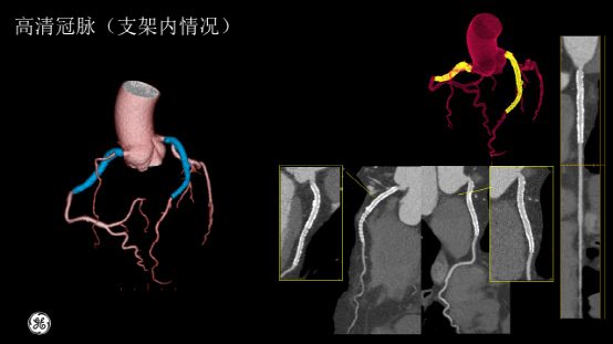 ge ct有哪些型号不怕超重 自由呼吸 ｜ GE Revolution CT显神奇，实现完美冠脉CTA检查！_https://www.jmylbn.com_新闻资讯_第21张
