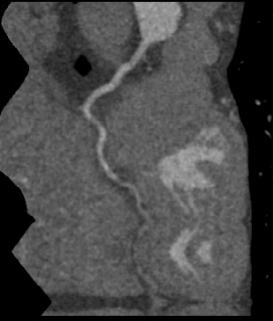 ge ct有哪些型号不怕超重 自由呼吸 ｜ GE Revolution CT显神奇，实现完美冠脉CTA检查！_https://www.jmylbn.com_新闻资讯_第11张