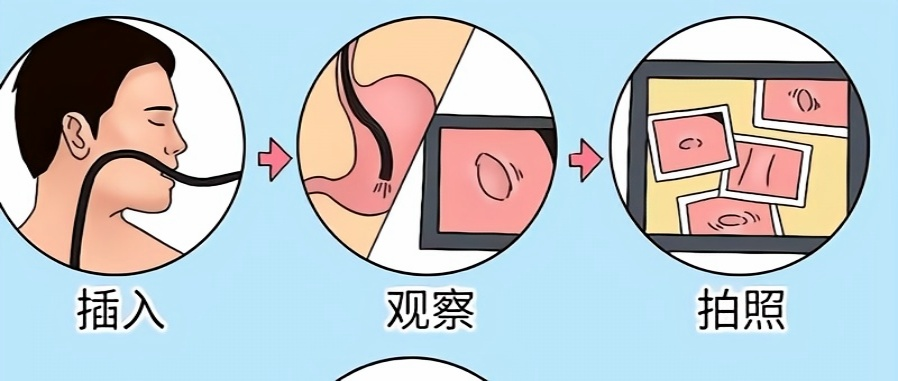 一次性活检钳检查什么【南医科普】关于胃肠镜检查的那些事儿_https://www.jmylbn.com_新闻资讯_第7张